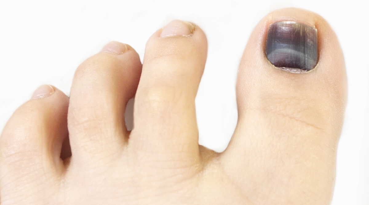 una negra en el pie causas gravedad y tratamiento